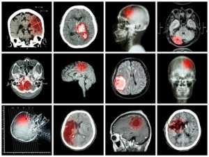 Collection Of Brain Disease