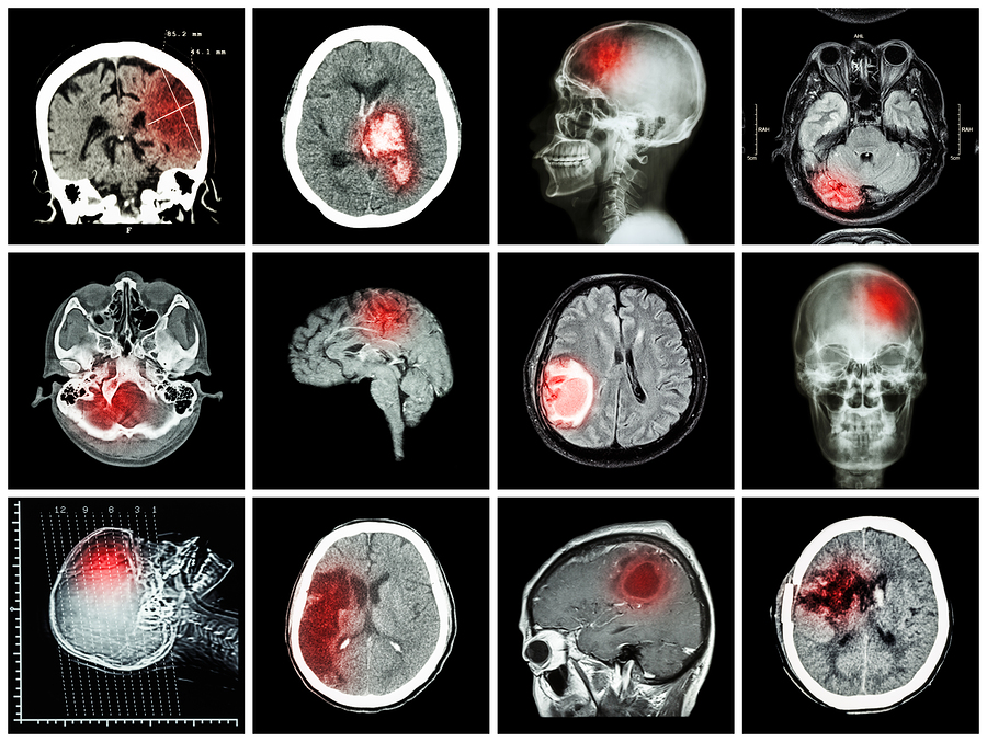Collection Of Brain Disease